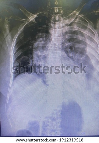 The picture of chest x-ray of patient who have left pleural effusion,Medical Technology and Science concept.