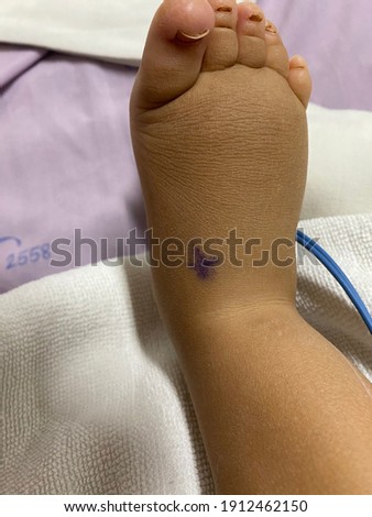 The picture of right foot of patient who have lymphedema  in the turner syndrome. Medical concept. 