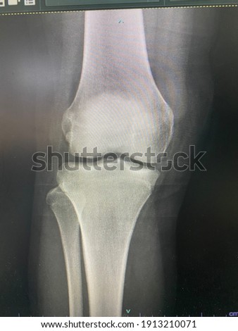 The picture of knee x-ray of patient who have large laceration wound at knee ,Medical Technology and Science concept.