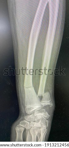 The picture of film x-ray of patient who have radius and ulna bone fracture,Medical Technology and Science concept.