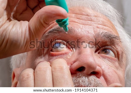 Self-instillation of eye drops in patients with glaucoma eyes. An elderly man with glaucoma. Royalty-Free Stock Photo #1914104371
