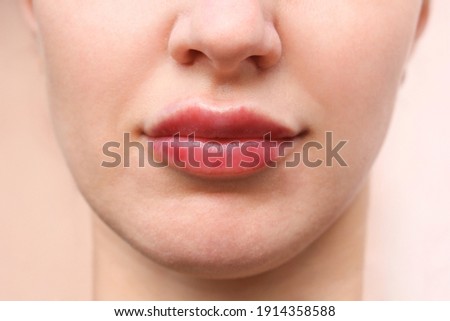 Healing of the lips after enlarging with fillers. Royalty-Free Stock Photo #1914358588