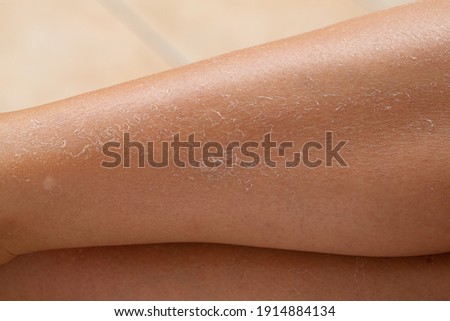 Detail of dry skin of woman legs. Dehydration due to the sun's rays without sun protection cream Royalty-Free Stock Photo #1914884134
