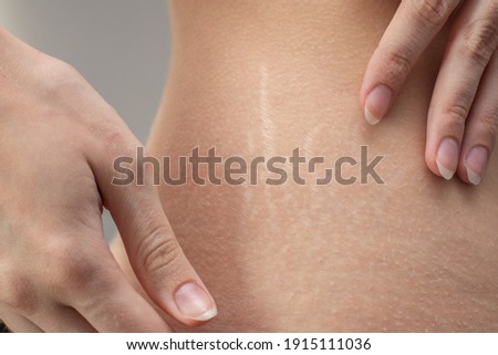 Woman hips with visible stretch marks. Young woman showing Stretch mark scars on her body. Royalty-Free Stock Photo #1915111036