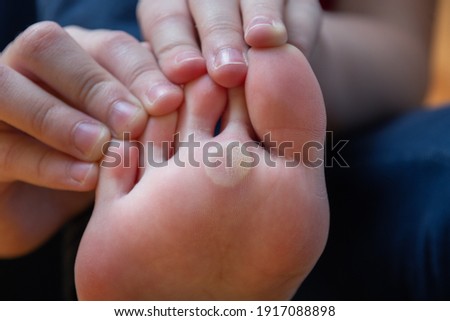 Children's foot with problem areas on the skin, dry corn. Plantar wart of the foot. Unhealthy foot skin concept. Beauty and health concept Royalty-Free Stock Photo #1917088898