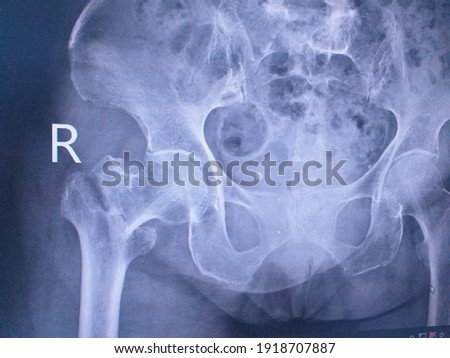 Broken or Fracture right femoral greater trochanter hips,Medical  image concept. Royalty-Free Stock Photo #1918707887