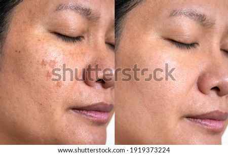 Image before and after spot melasma pigmentation facial treatment on middle age asian woman face. skincare and health problem concept.  Royalty-Free Stock Photo #1919373224