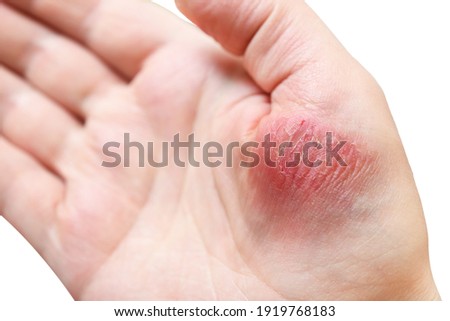 Atopic dermatitis (AD), also known as atopic eczema, is a type of skin inflammation (dermatitis) on the  hand.