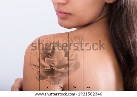 Laser Tattoo Removal On Woman's Shoulder Against White Background Royalty-Free Stock Photo #1921582346