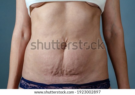 Abdominal skin of a woman with stretch marks after childbirth Royalty-Free Stock Photo #1923002897