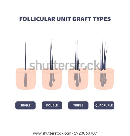 Hair micrograft classification set for hair transplantation surgery. Skin cross-section with number of hairs in the follicular unit or family. Hair science and anatomy. Cartoon vector illustration. Royalty-Free Stock Photo #1923060707