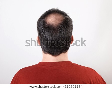male head with thinning hair or alopecia Royalty-Free Stock Photo #192329954