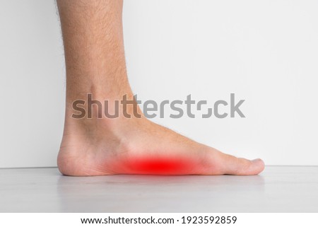 Foot pain because of strong flat feet also called pes planus or fallen arches. The arches on the inside of feet are flattened Royalty-Free Stock Photo #1923592859