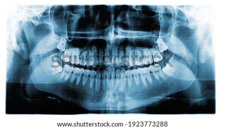 Panoramic dental tooth X-ray of a 17 year old teenage male Royalty-Free Stock Photo #1923773288
