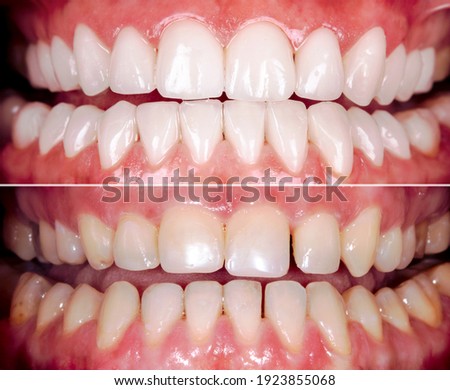 Perfect smile before and after bleaching procedure whitening of zircon arch ceramic prothesis Implants crowns. Dental restoration treatment clinic patient. Result of oral surgery dentistry, Royalty-Free Stock Photo #1923855068