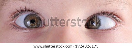 Child's face with squint and freckles on nose. Strabismus in children causes and treatment concept Royalty-Free Stock Photo #1924326173