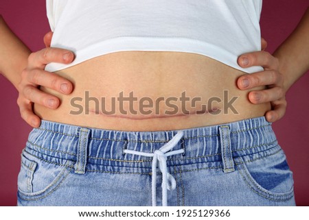 woman shows the scar of caesarean section on stomach Royalty-Free Stock Photo #1925129366