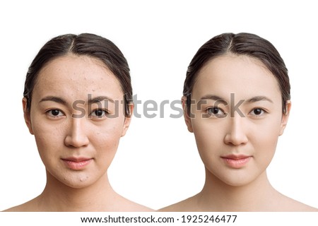 the concept of skin care before, after. young asian woman with bad skin with wrinkles and acne and after with perfect skin. comparison of the result Royalty-Free Stock Photo #1925246477