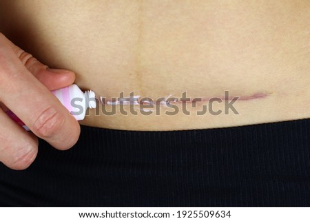 woman applies ointment to the cesarean section scar. The concept of postpartum recovery