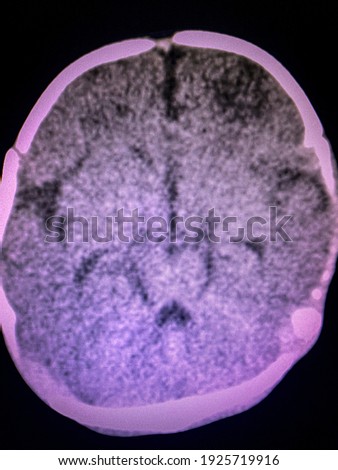 The picture of Brain computed tomography of a human,Medical Technology and Science concept. CT scan brain show acute to subacute infarction at bilateral ACA-MCA watershed and bilateral PCA territory 