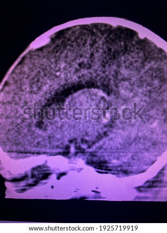 The picture of Brain computed tomography of a human,Medical Technology and Science concept. CT scan brain show acute to subacute infarction at bilateral ACA-MCA watershed and bilateral PCA territory 