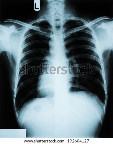 X-Ray Image of human chest for a medical diagnosis