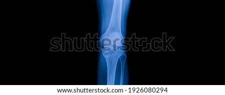 Photo of plain radiograph on dark background in hospital.The film use for diagnosis the illness of patient.The picture shown broken knee bone.Tibial plateau fracture in accident patient.