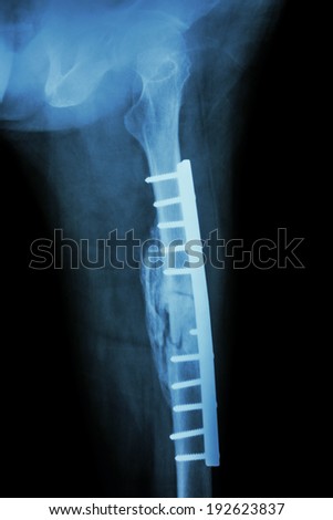 Fracture shaft of femur. It was operated and internal fixation by plate & screw Royalty-Free Stock Photo #192623837