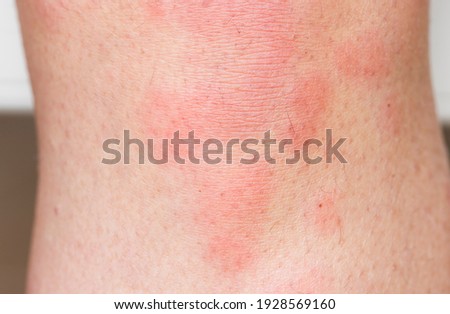 Hives on skin, red urticaria rash on a woman's body. Depicts skin allergies or skin infections, UK Royalty-Free Stock Photo #1928569160