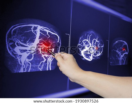 Close up Hand doctor point MRA brian scan image of a recent traumatic brain injury patient showing brain contusion and hemorrhage.Medical image concept. Royalty-Free Stock Photo #1930897526