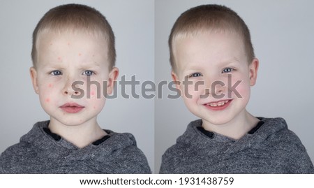 Before and after. The child shows a face with a lot of red allergic acne. The second picture shows a clean face without any allergies. The concept of the treatment of children's rashes. Chickenpox