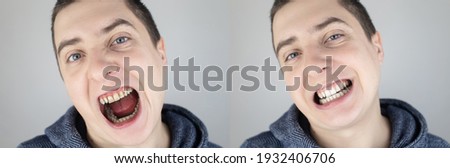 Before and after. The man shows the damaged teeth by caries, and in the second picture the dentist's work on the restoration of teeth. Man caries, treatment, recovery