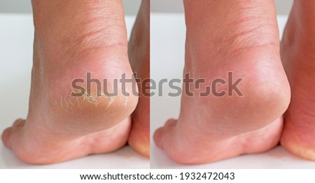 Image before and after treatment of dry heels cracks skin dehydrated skin on heels of female feet. Royalty-Free Stock Photo #1932472043