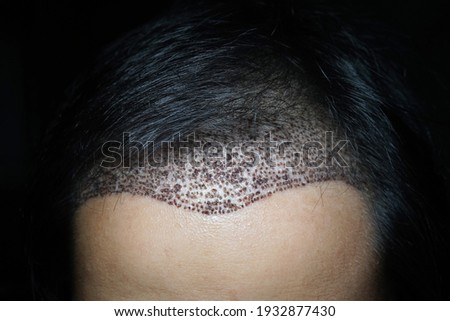 FUE hair transplant in dark environment Royalty-Free Stock Photo #1932877430