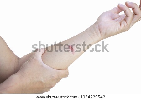 Scald arm is isolated from a white background Royalty-Free Stock Photo #1934229542
