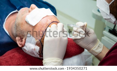 Patient's head close-up. Baldness treatment. Hair transplant. Surgeon in the operating room carry out hair transplant surgery.  Royalty-Free Stock Photo #1934350271