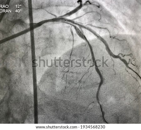 Drug eluting stent (DES) deployed at left anterior descending artery (LAD) to diagonal branch (DG). Coronary bifurcation percutaneous coronary intervention. Royalty-Free Stock Photo #1934568230