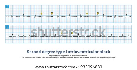 With atypical second-degree type I atrioventricular block, the PR interval is not progressively prolonged.