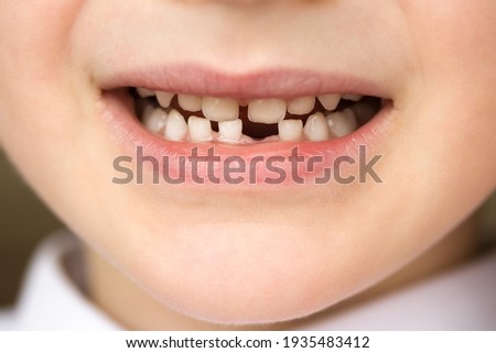 The smile of a five and a half year old boy whose first milk tooth and lower incisor fell out Royalty-Free Stock Photo #1935483412