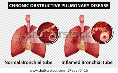 Diagram showing chronic obstructive pulmonary disease on transparent background illustration