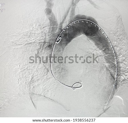 Angiogram of aorta shown aortic dissection type B at descending aorta during Thoracic endovascular aortic repair (TEVAR). Royalty-Free Stock Photo #1938556237