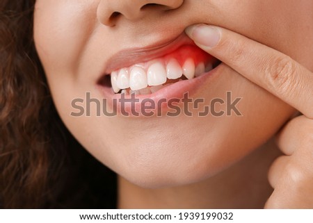 Woman with gum inflammation, closeup Royalty-Free Stock Photo #1939199032