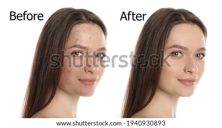 Young woman before and after cosmetic procedure on white background Royalty-Free Stock Photo #1940930893