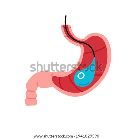 Gastric balloon isolated vector illustration. Weight loss, obesity control, surgery procedure design element. 