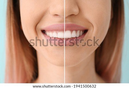 Young woman before and after procedure of gingival plasty, closeup Royalty-Free Stock Photo #1941500632