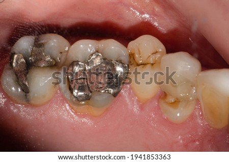 A large amalgam or metal-mercury fillings on molar teeth and premolar tooth fracture Royalty-Free Stock Photo #1941853363