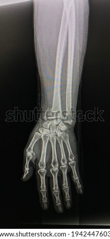 The picture of film x-ray right hand  of patient who have distal end radius fracture, Medical Technology and Science concept.