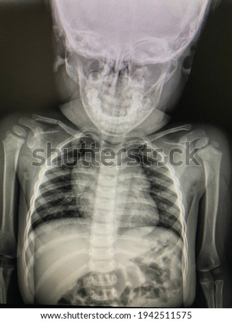 The picture of chest x-ray of pediatric patient who have right clavicle fracture, Medical Technology and Science concept.