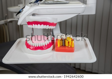 Plastic dental crowns, imitation of a dental prosthesis of a dental bridge for three teeth with a metal screw implant
