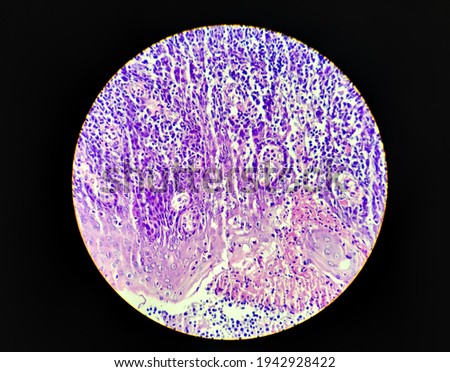 Microscope picture of breast cancer
